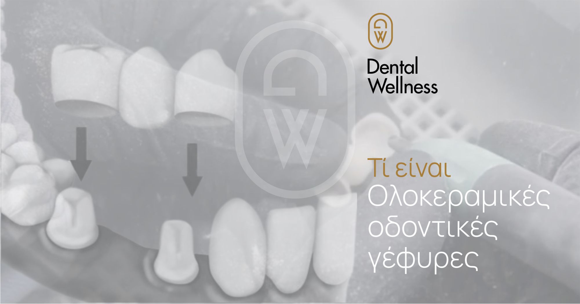 Τι είναι οι Ολοκεραμικές οδοντικές γέφυρες