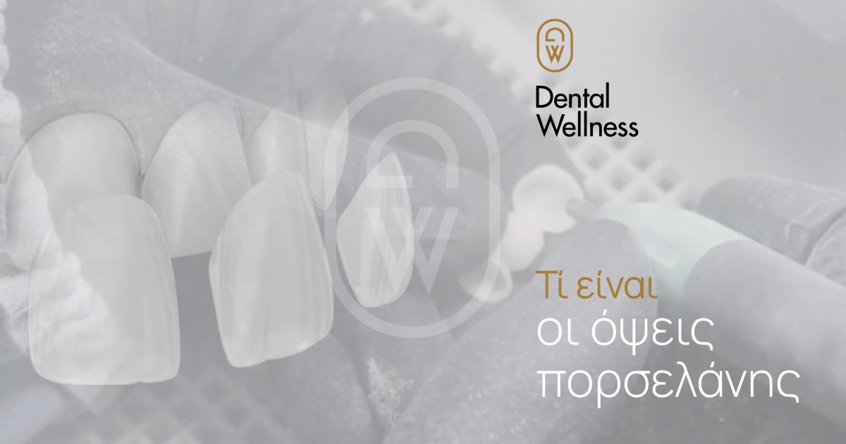 Τι είναι οι όψεις πορσελάνης